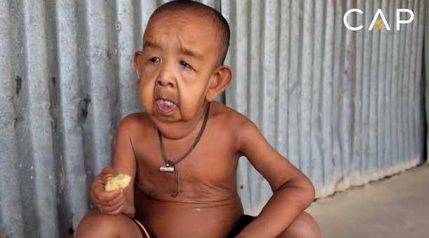 El Verdadero Benjamin Button Conozca Al Bebe De Cuatro Anos Que Parece De 80 Telemar Campeche Tv