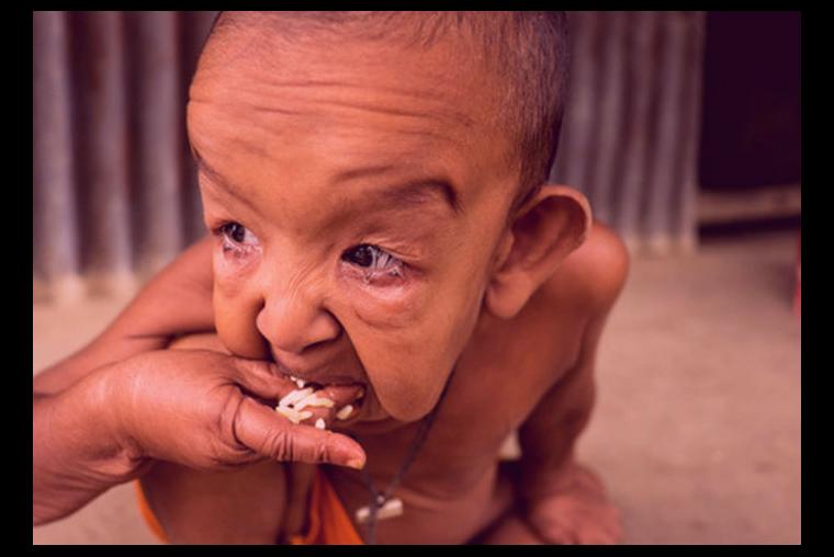 El Verdadero Benjamin Button Conozca Al Bebe De Cuatro Anos Que Parece De 80 Telemar Campeche Tv